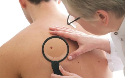 Campaña de prevención: control gratuito de lunares en el Hospital Mi Pueblo